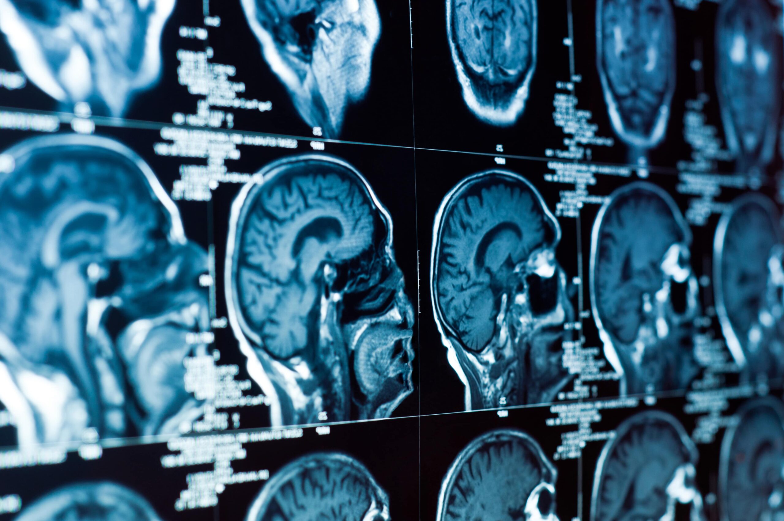 You are currently viewing What To Expect In Brain Injury Cases
